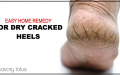 Easy Home Remedy for Dry Cracked Heels